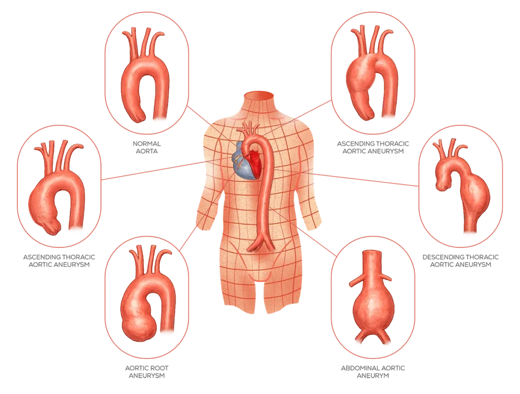 Type of aneurysms illustration